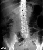 Lumboperitoneal shunt
