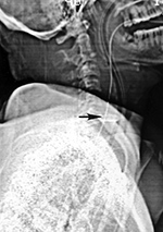 Nasotracheal and orogastric tubes