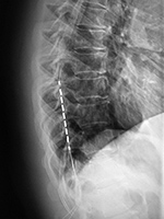 Thoracic spine neurostimulator leads lateral view