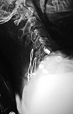 Posterior cervical wire fixation figure of 8