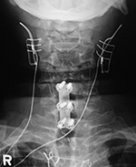 Bilateral vagus nerve stimulators