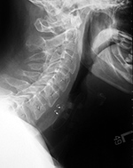 Vagus nerve stimulator lateral view