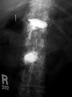 Vertebroplasty
