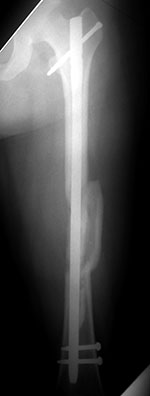 Antegrade IM femoral nail
