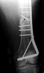 Blade plate