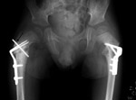 Pelvis blade plates