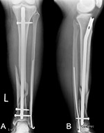 Intramedullary nail and Rush rod