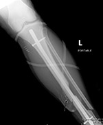 Intramedullary nail and wound vac