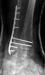 Locking low contact dynamic compression plate