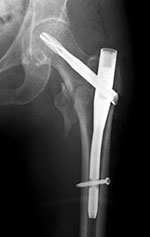 Short hip nail