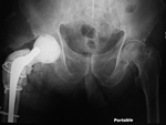 Antibiotic laden temporary prosthesis
