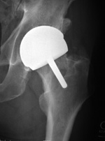 Femoral head resurfacing
