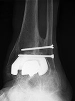Total ankle arthroplasty