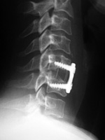 ACDF disk cage