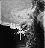 Occipital stut and posterior cervical spine fixation
