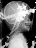 Cranial tongs