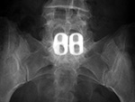 Lumbar spine disk spacer