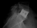 Lumbar spine disk spacer