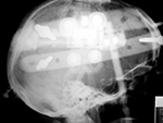Head tongs lateral view