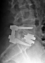 Lumbar disk replacement