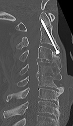 Odontoid fracture fixation and PSF sagittal CT