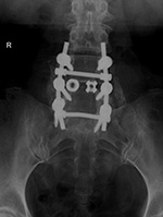 Posterior spinal fusion apparatus