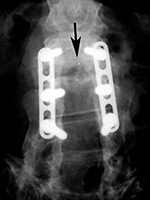 Pedicle plates and screws