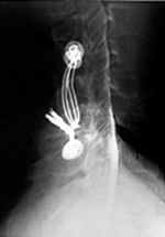 Posterior cervical spine wiring lateral view