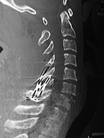 Posterior cervical wire fixation figure of 8 CT