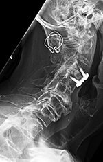 Posterior spinal wiring