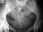 Sacral stimulator