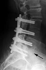 Steffee plates lateral view