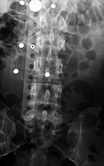 TLSO brace