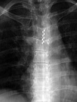 Thoracic spinal cord neurostimulator