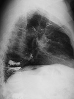 Vertebroplasty cement embolization