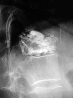 Vertebroplasty extruded cement