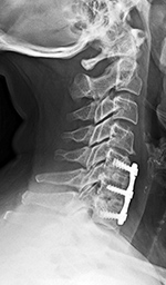 Junctional disease at C4-5 above ACDF at C5-7