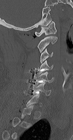 Posterior cervical screws are in facet joints
