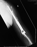Revision total elbow arthroplasty