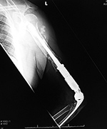 Revision total elbow arthroplasty