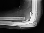 Infected left elbow prosthesis