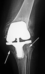 Particle disease in constrained TKA