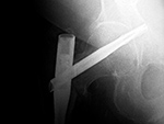 Right femoral neck helical screw displacement