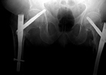 Right femoral neck helical screw displacement
