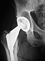 Osteolysis and hip particle disease