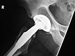 Osteolysis and particle disease in hip replacement