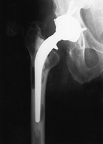 Femoral osteolysis in zones 2, 5, and 7