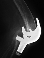 Disrupted left total knee prosthesis lateral view 