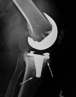 Left knee TKA 6.5 years postoperative