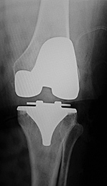Left TKA after surgery